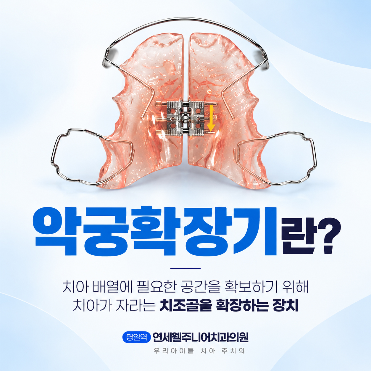 중학생 비발치 치아교정 시 치아 배열 공간 확보에 사용하는 악궁확장기 장치의 구조와 형태