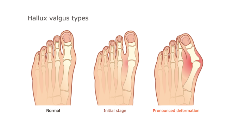 발가락 통증 치료