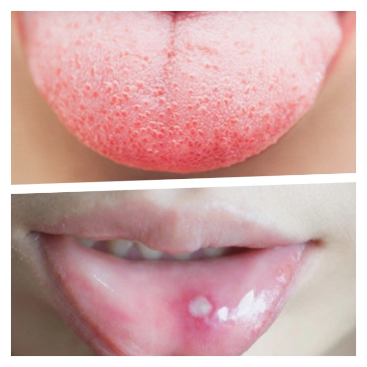 혓바늘과-구내염-차이