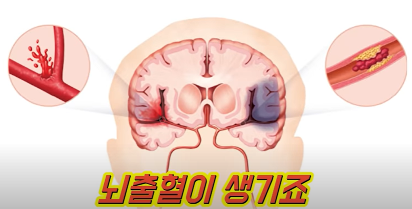 고혈압 합병증