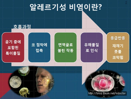 알레르기 비염 치료 민간요법