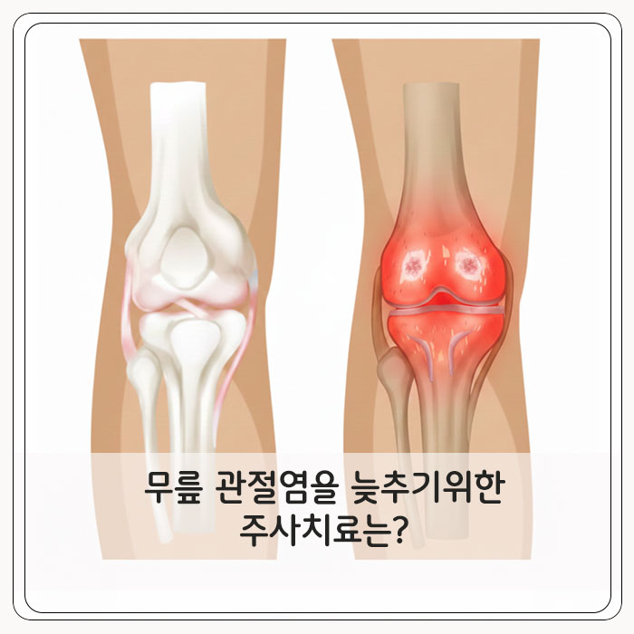 무릎 관절염을 늦추기 위한 주사치료는?