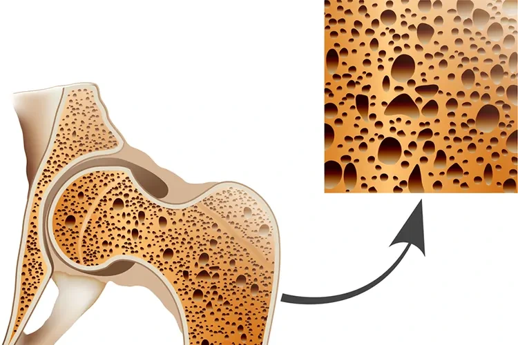 골다공증-골밀도-단면도
