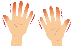 화상을 입으면 왜 물집이 생기나요