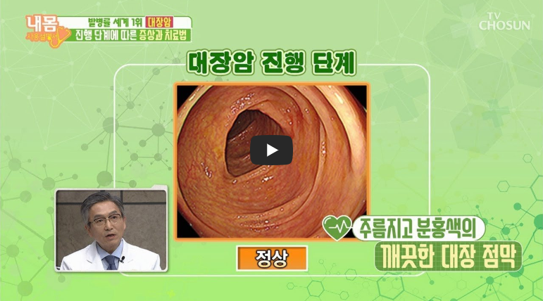 대장암