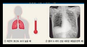 폐렴 예방접종 가격 시기