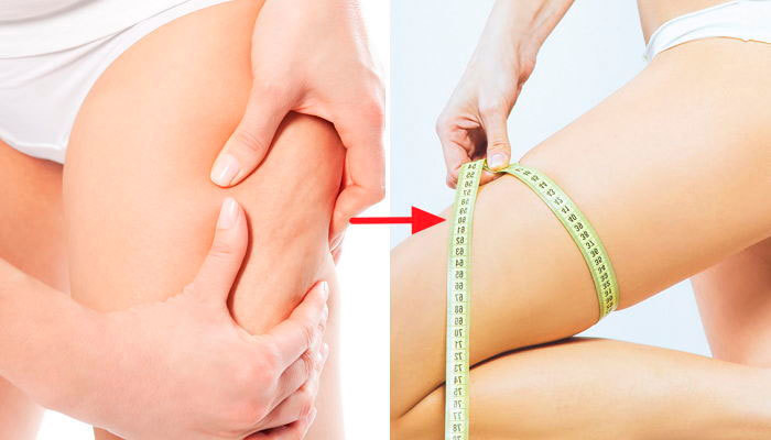 다리 셀룰라이트 없애는 방법 6가지