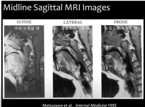 옆으로 누웠을 때 기도가 확보되는 사진