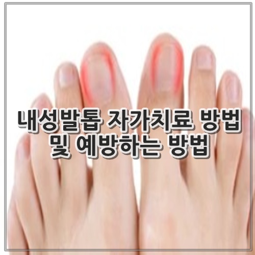 내성발톱 자가치료 방법 및 예방하는 방법