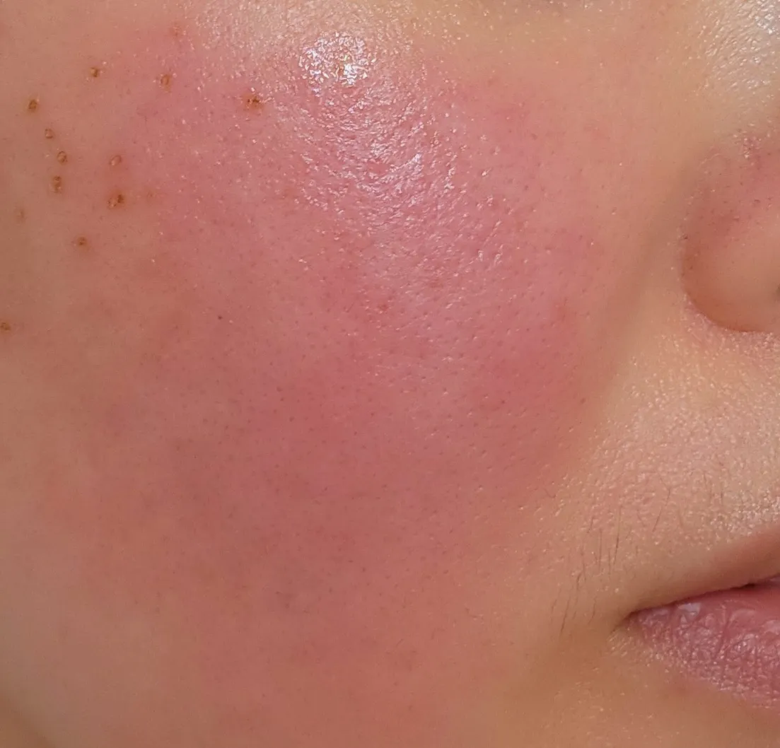 주사피부염으로-붉어진-홍조-피부-이미지