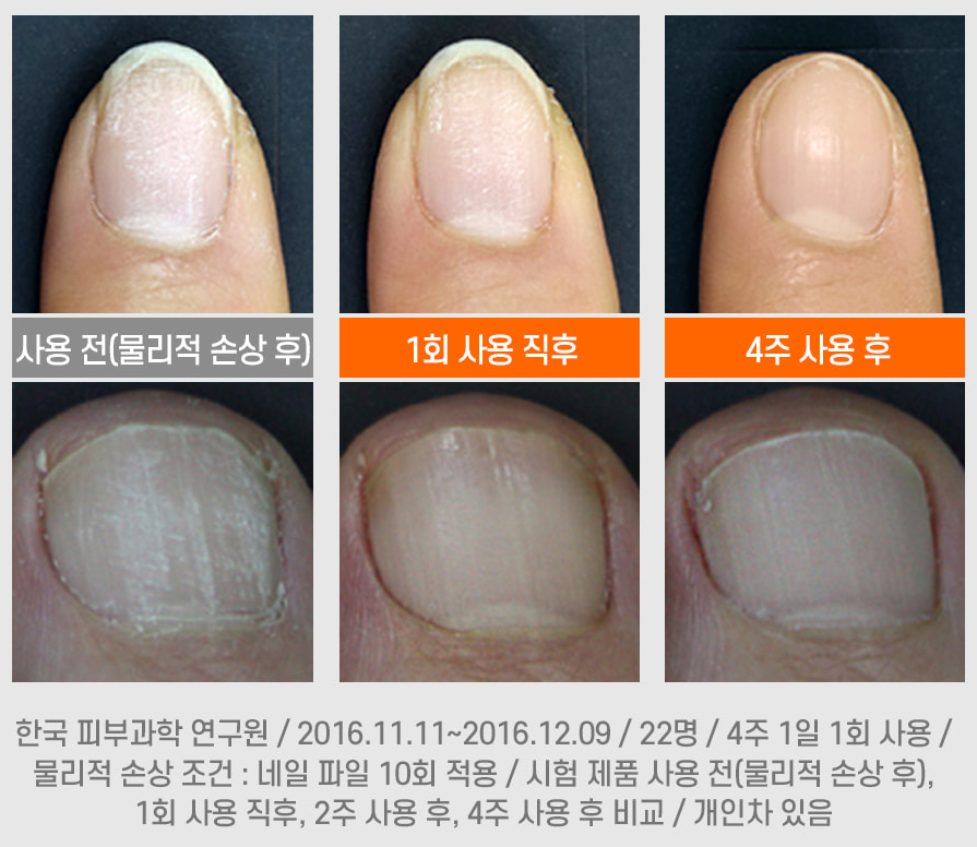 발톱무좀 케라셀네일