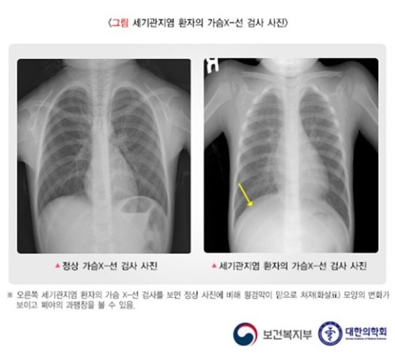 세기관지염(브론키올라이티스) 환자의 흉부 x-선 검사 사진을 정상인의 거소가 비교하여 보여주는 사진.