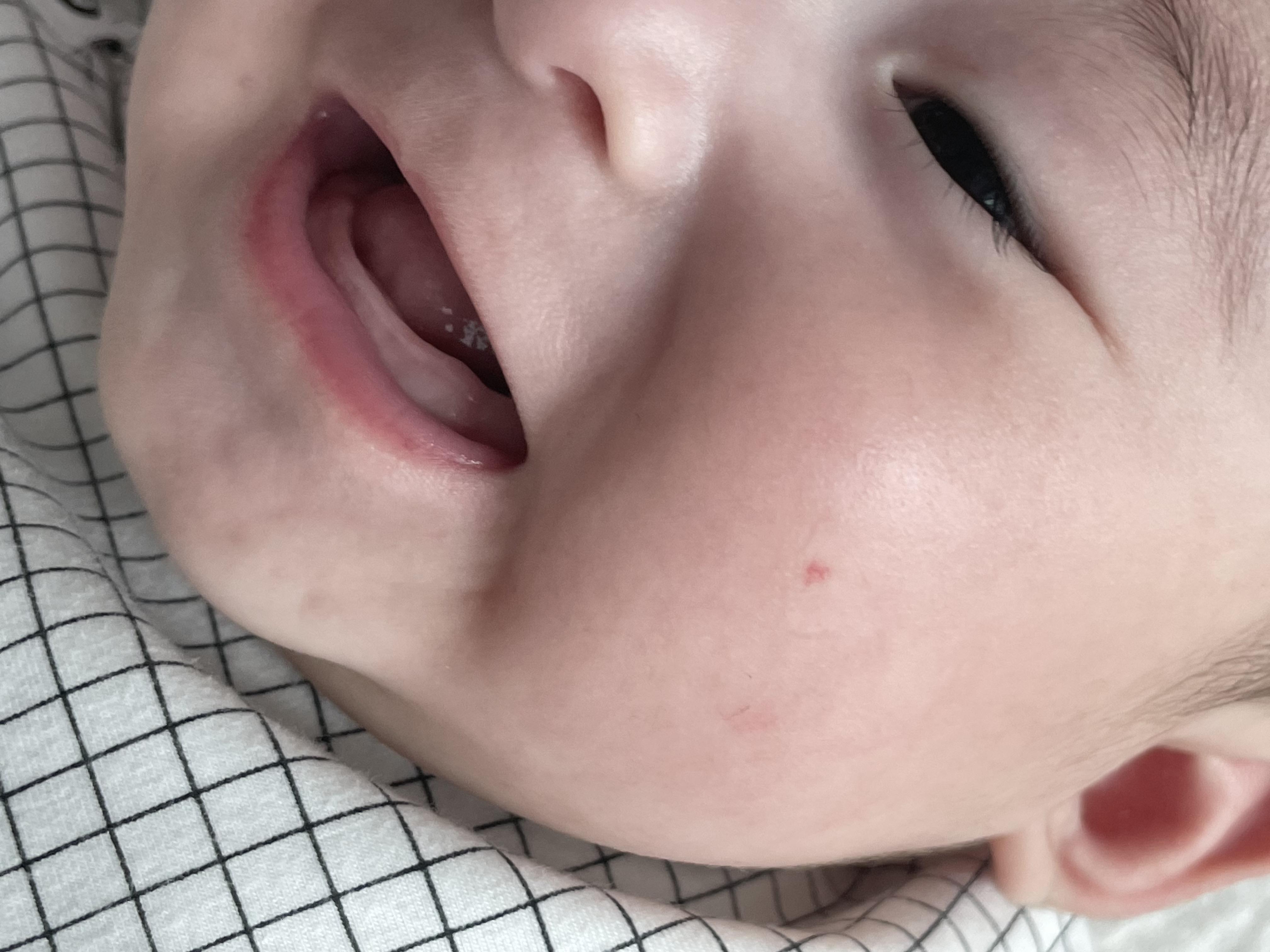 혈관종 에스앤유 피부과