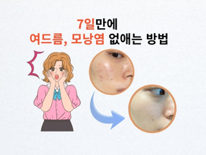 여드름 없애기