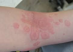 홍반증이 나타난 팔