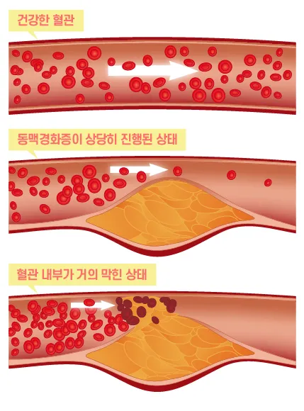 LDL 콜레스테롤 정상수치 낮추는법_4