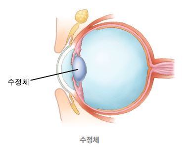 백내장 초기증상