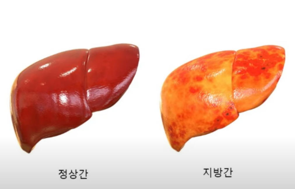 정상간 지방간 차이