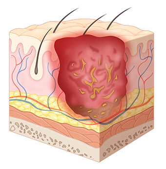 욕창 회복 기간과 단계별 회복 속도 비교