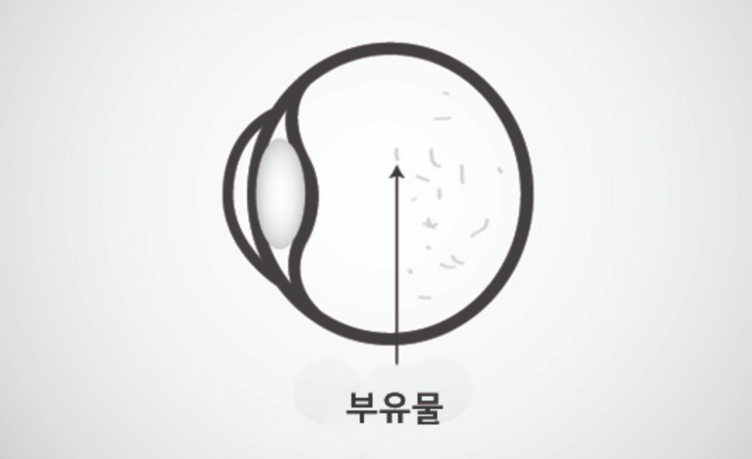 비문증-사진