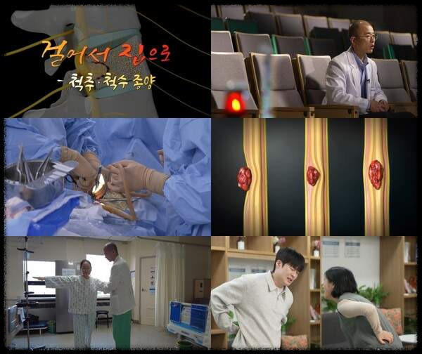 척추척수 종양-증상,회복,수술