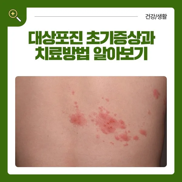 대상포진 치료방법에 대한 총정리 건강 질병관리_2