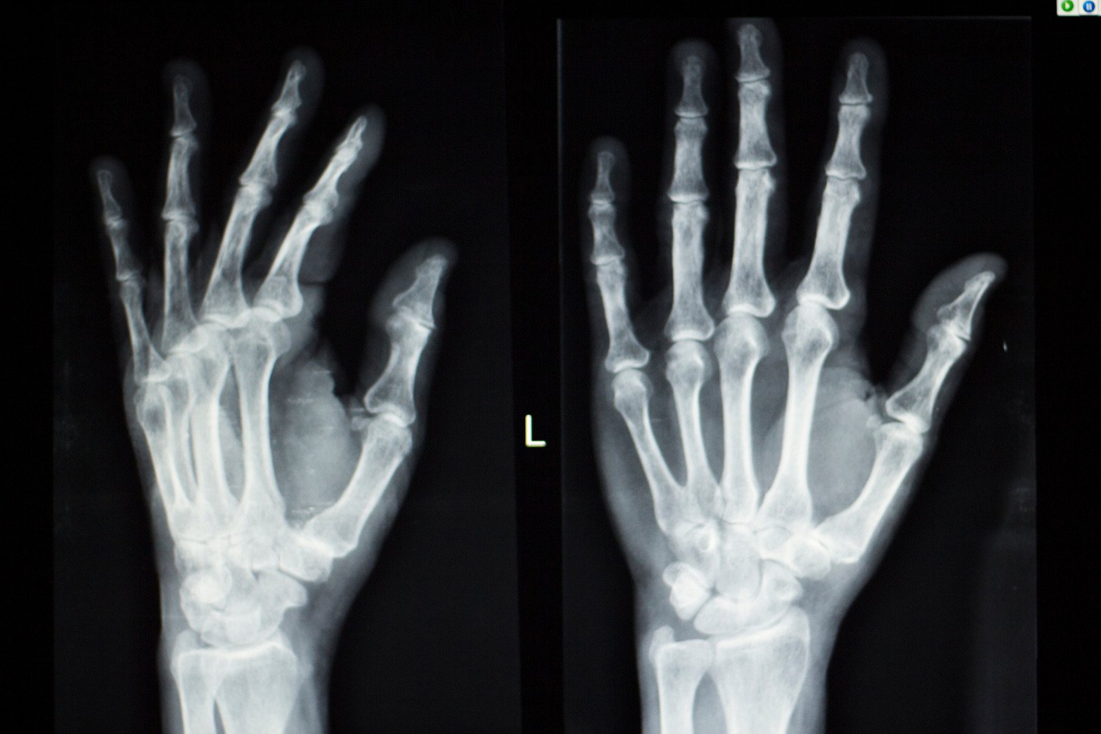 골연령 검사 (Bone Age Test): 정의, 과정, 중요성 및 적용