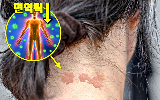 면역력이 떨어졌을때 증상 대상포진 면역력 저하 증상,건강 팁줌 매일꿀정보