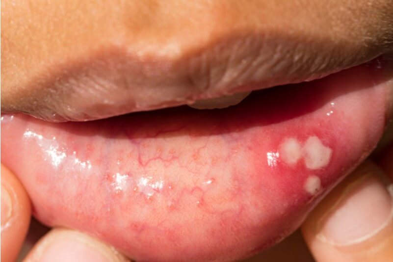 구내염-전염성