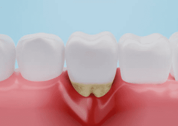 잇몸 염증 치료약