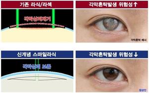 각막혼탁