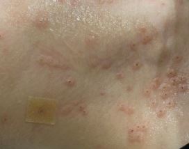 편평사마귀 없애는 방법