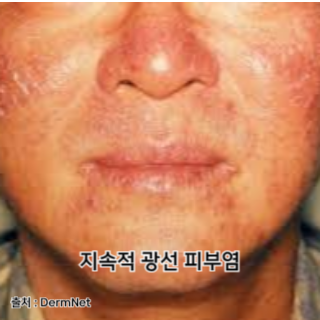 햇빛-알레르기-증상