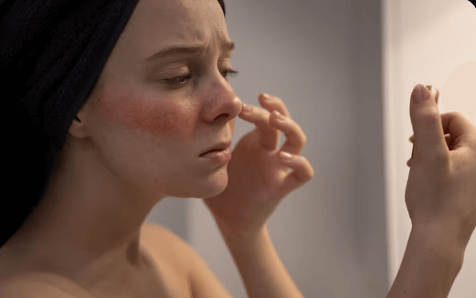 안면홍조 vs 주사피부염&amp;#44; 닮았지만 완전히 다른 빨간 얼굴 고민~!