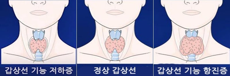 갑상선 기능 저하증 증상