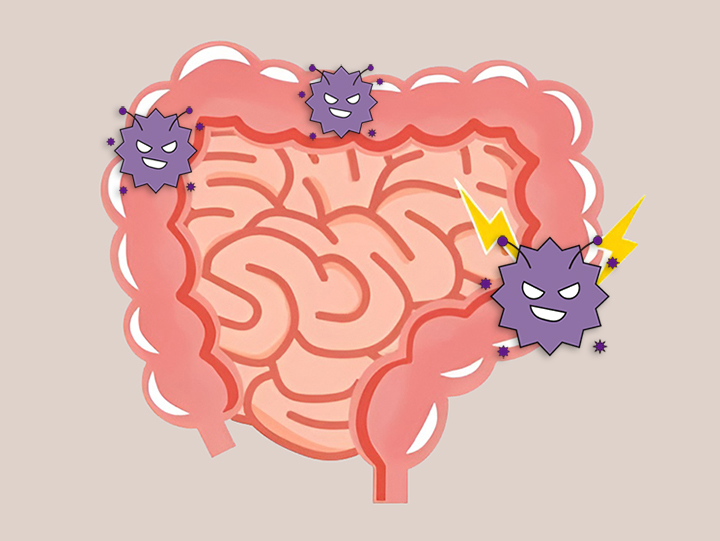 염증이-있는-장의-모습