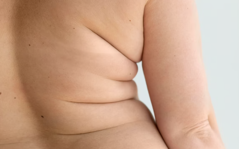 고도비만 치료방법