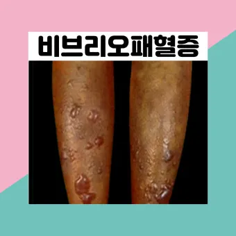 패혈증이란 무엇인지 원인 증상 치료 예방법_12