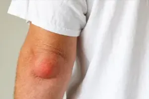 팔꿈치