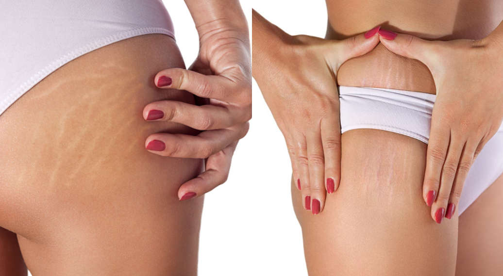 허벅지-어덩이-튼살