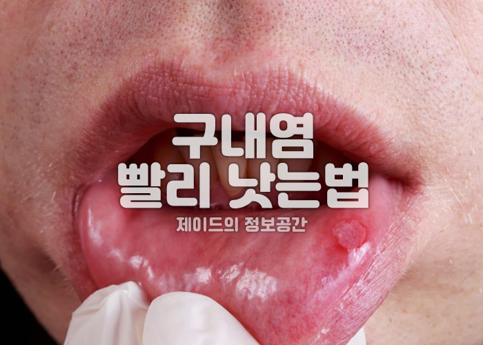 구내염 증상 이미지