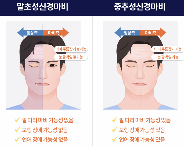 구안와사 증상 이미지