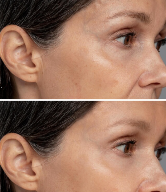 트라넥삼산 선크림을 꾸준히 사용한 후 변화 이미지