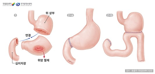 위아전절제술
