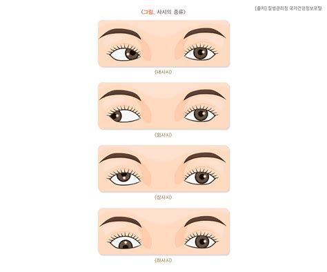 성인 사시 수술