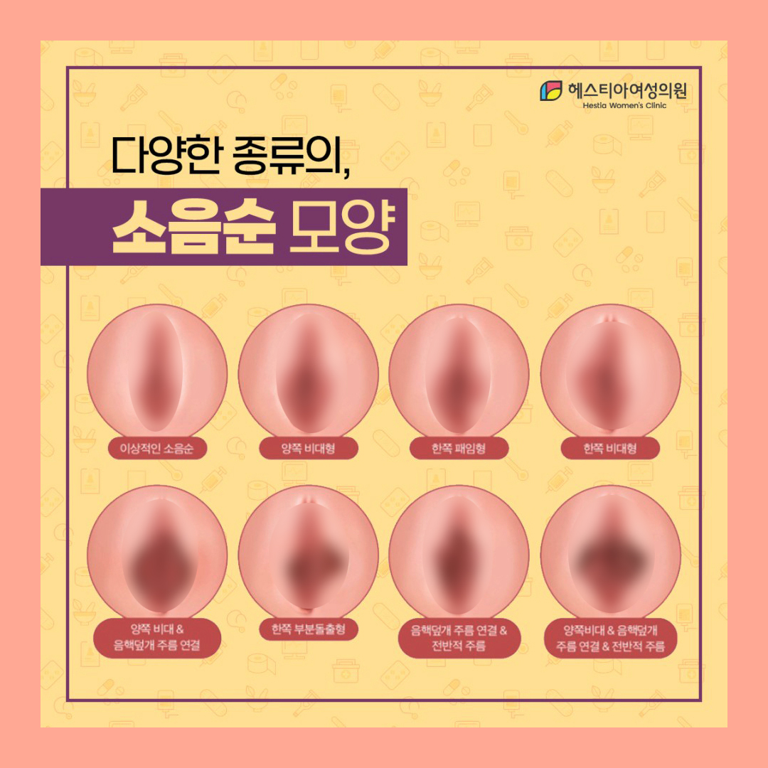 다양한 종류의 소음순모양
