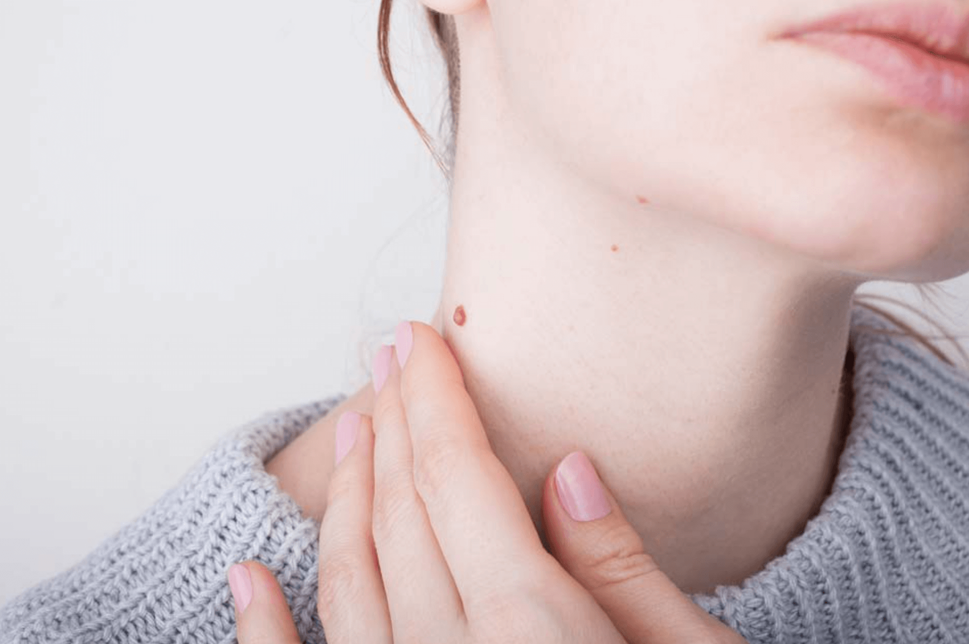 쥐젖 제거 후기