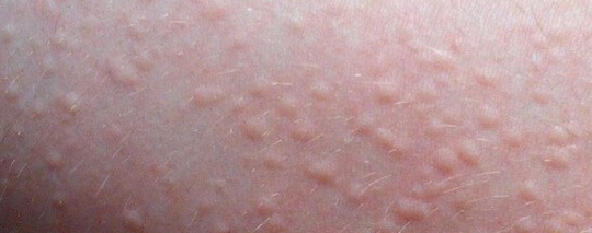 두드러기 원인3