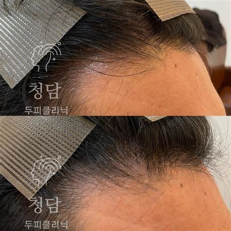 천안 탈모