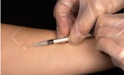 항생제_피부반응검사